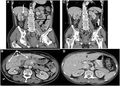 Dual Paraneoplastic Endocrine Syndromes Heralding Onset of Extrapulmonary Small Cell Carcinoma: A Case Report and Narrative Review